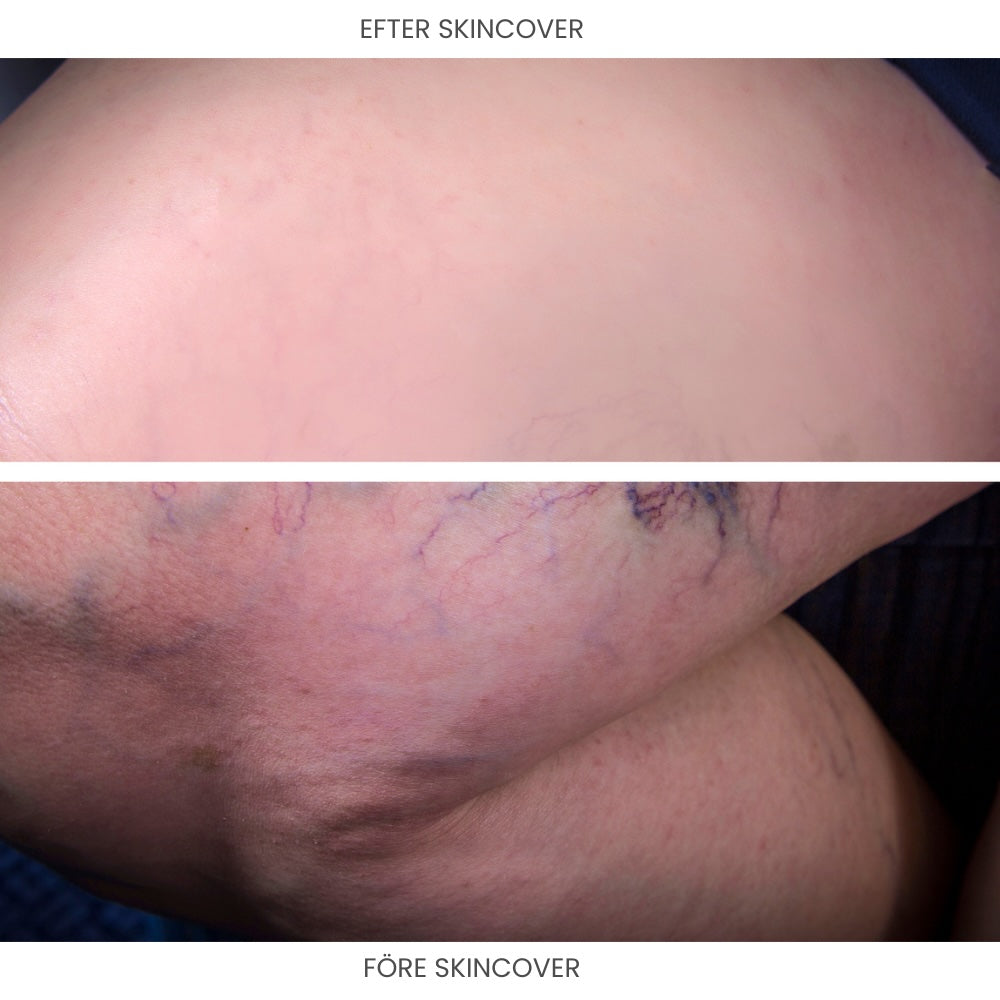 bc:ba_veins
